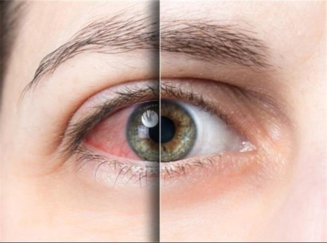 سندرم خشکی چشم چیست؟ علل و درمان