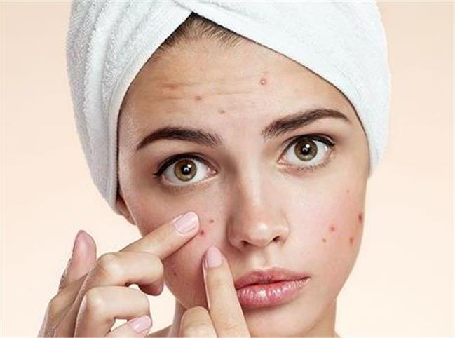 7 اشتباه در مراقبت از پوست که می تواند شما را دچار آکنه کند