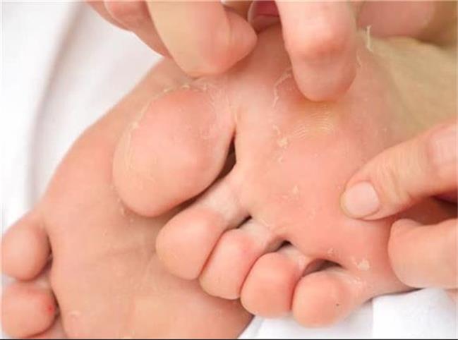۵ دلیل رایج پوسته پوسته شدن کف پا