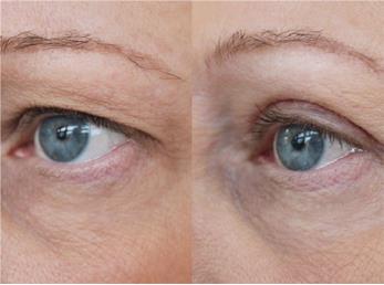 درمان خانگی افتادگی پلک