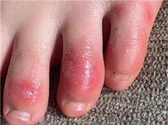 تازه‌ترین نشانه کرونا را بشناسید