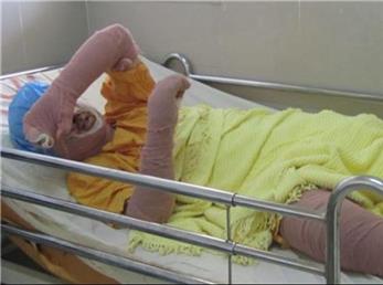 دختر ۱۸ ساله رشتی به دست برادرش در آتش سوخت