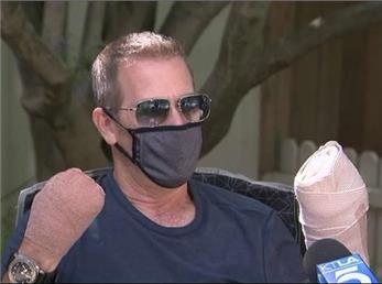 قطع دستان یک مرد به دلیل کرونا