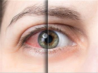 سندرم خشکی چشم چیست؟ علل و درمان