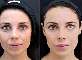 مزوژل چست و چه کاربردهایی در زیبایی دارد؟