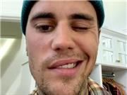 جاستین بیبر خواننده معروف کانادایی و بیماریِ عجیب‌اش!