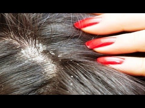 درمان شوره سز با روغن درخت چای